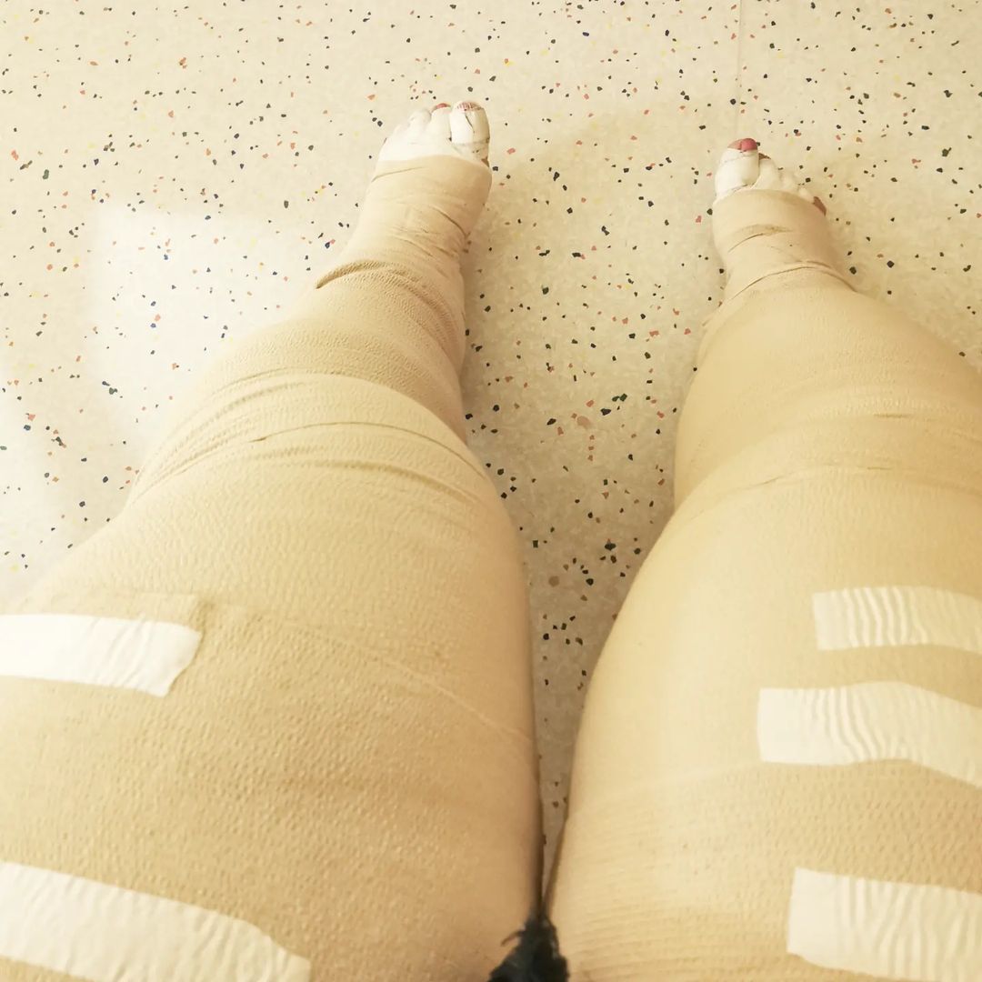 und so sieht das aus, wenn man Bandagiert ist. Es befindet sich 4 Zinkleimverbände, 16 Bandagen und 8 Langzugbinden auf meinen Beinen, daher sehen sie auch sehr dick und unförmig aus.